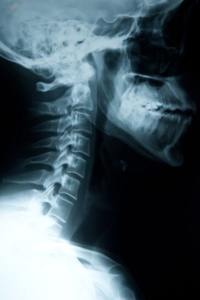 X-ray of a neck